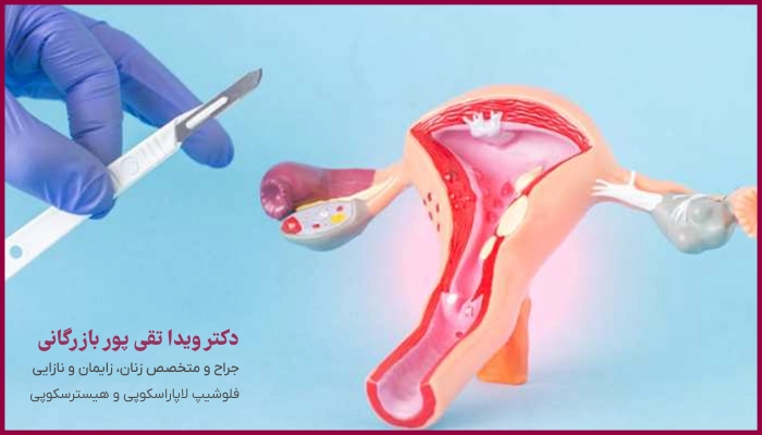 اندومتریوز چیست؟