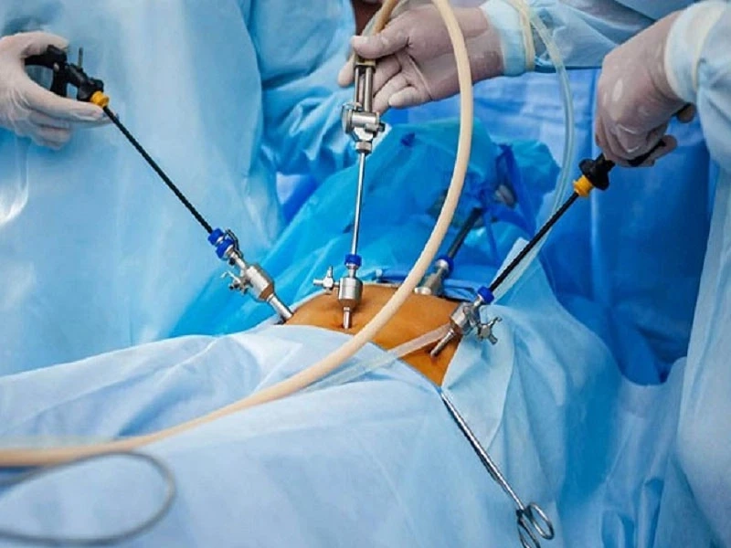 آمادگی‌های لازم قبل از لاپاراسکوپی رحم
