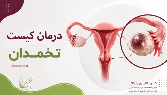 انواع کیست تخمدان