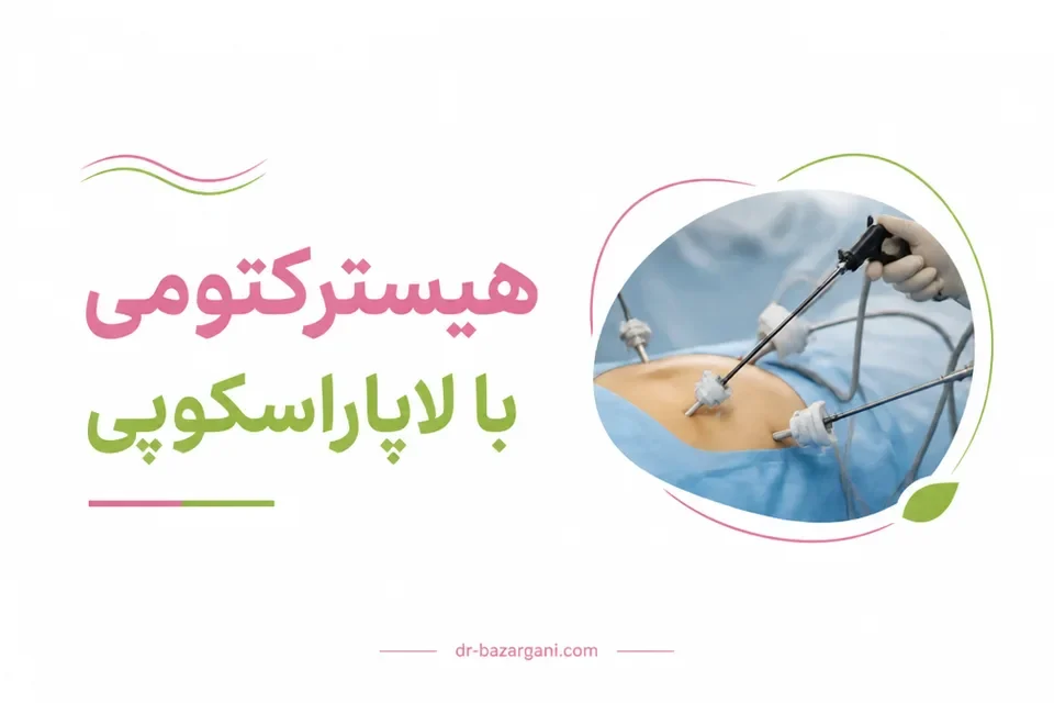 هیسترکتومی با لاپاراسکوپی