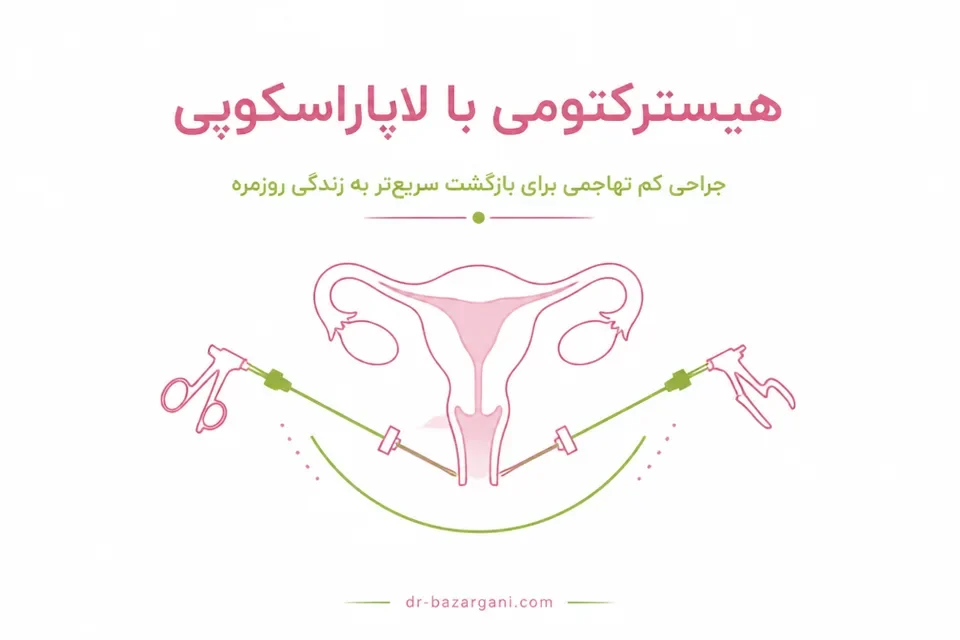 هیسترکتومی با لاپاراسکوپی
